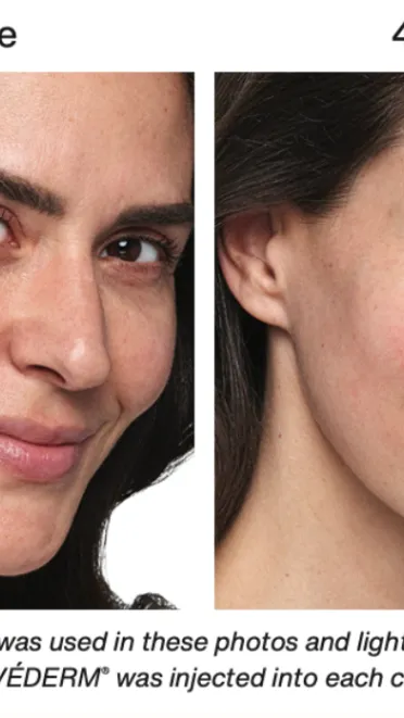 Juvederm Skinvive [1ml] 1