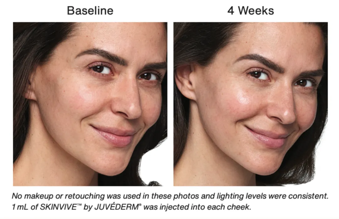 Juvederm Skinvive [1ml]