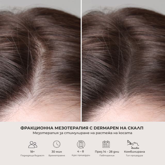 Mesotherapy for Hair Regrowth and Scalp Vitality