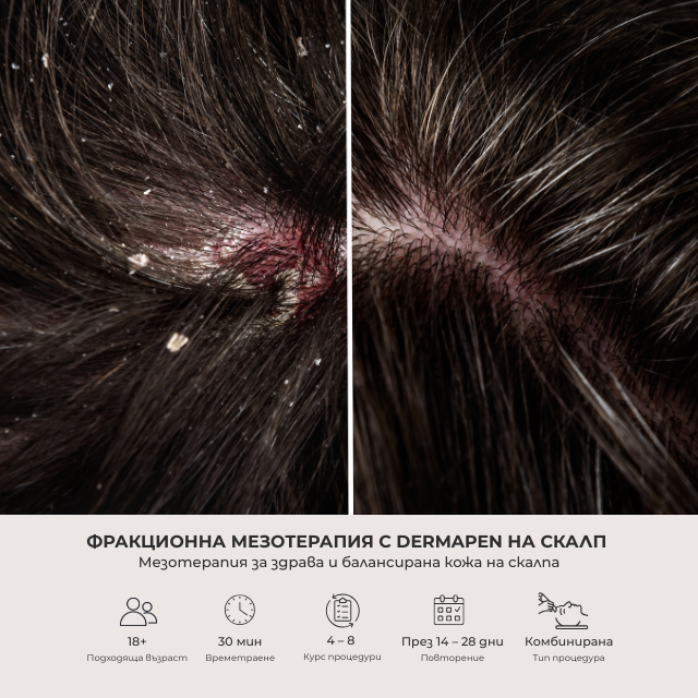 Mesotherapy to Restore Scalp Health and Balance