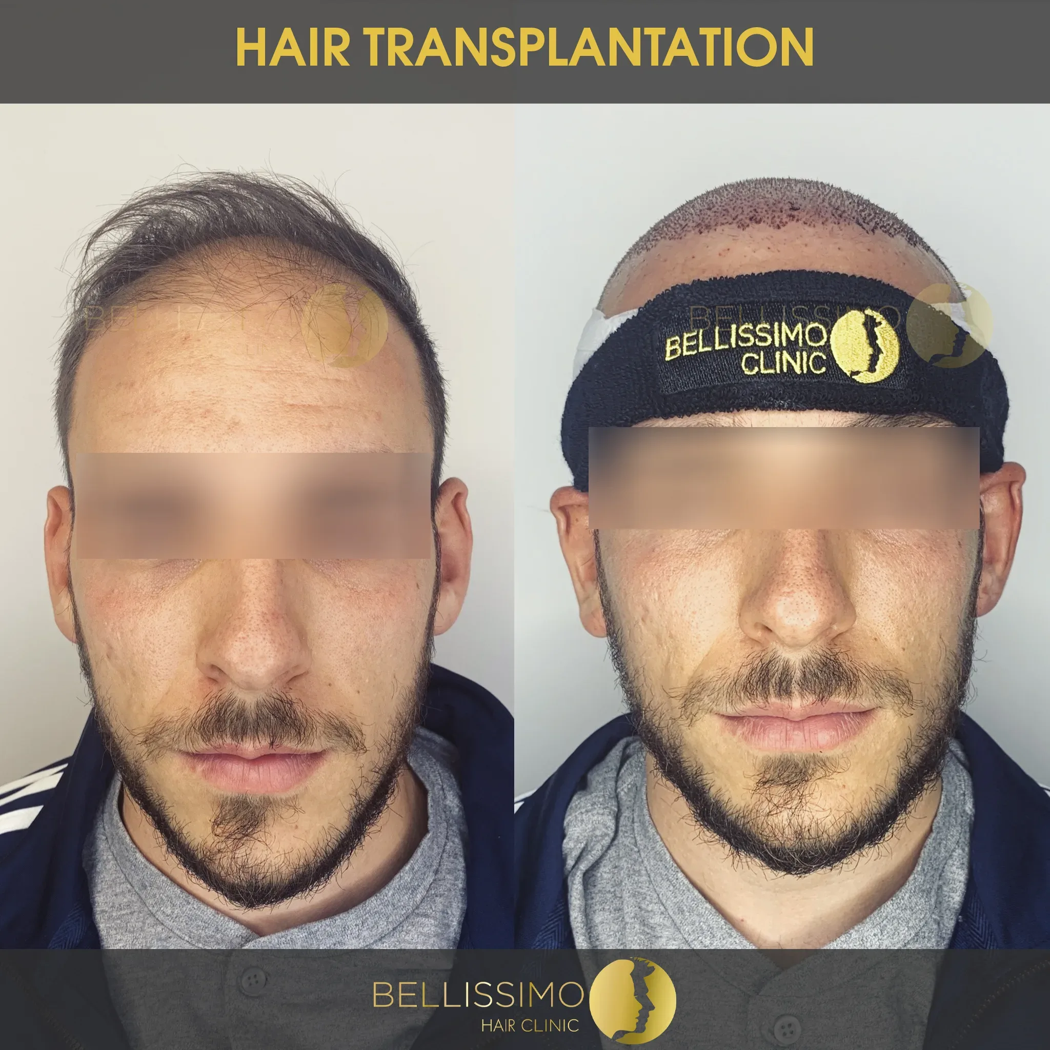 Трансплантация на коса — пациент на Bellissimo Clinic