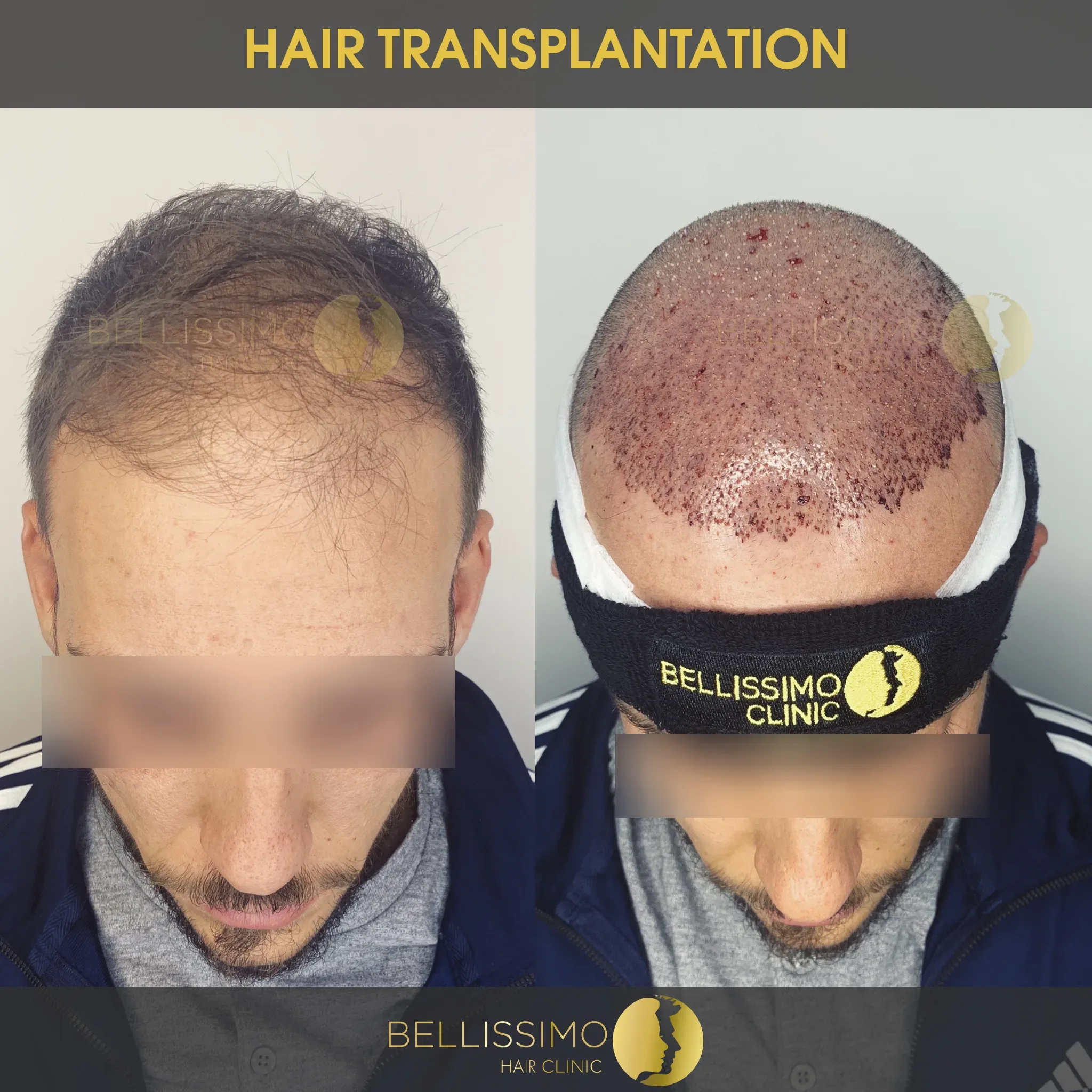 Трансплантация на коса — пациент на Bellissimo Clinic