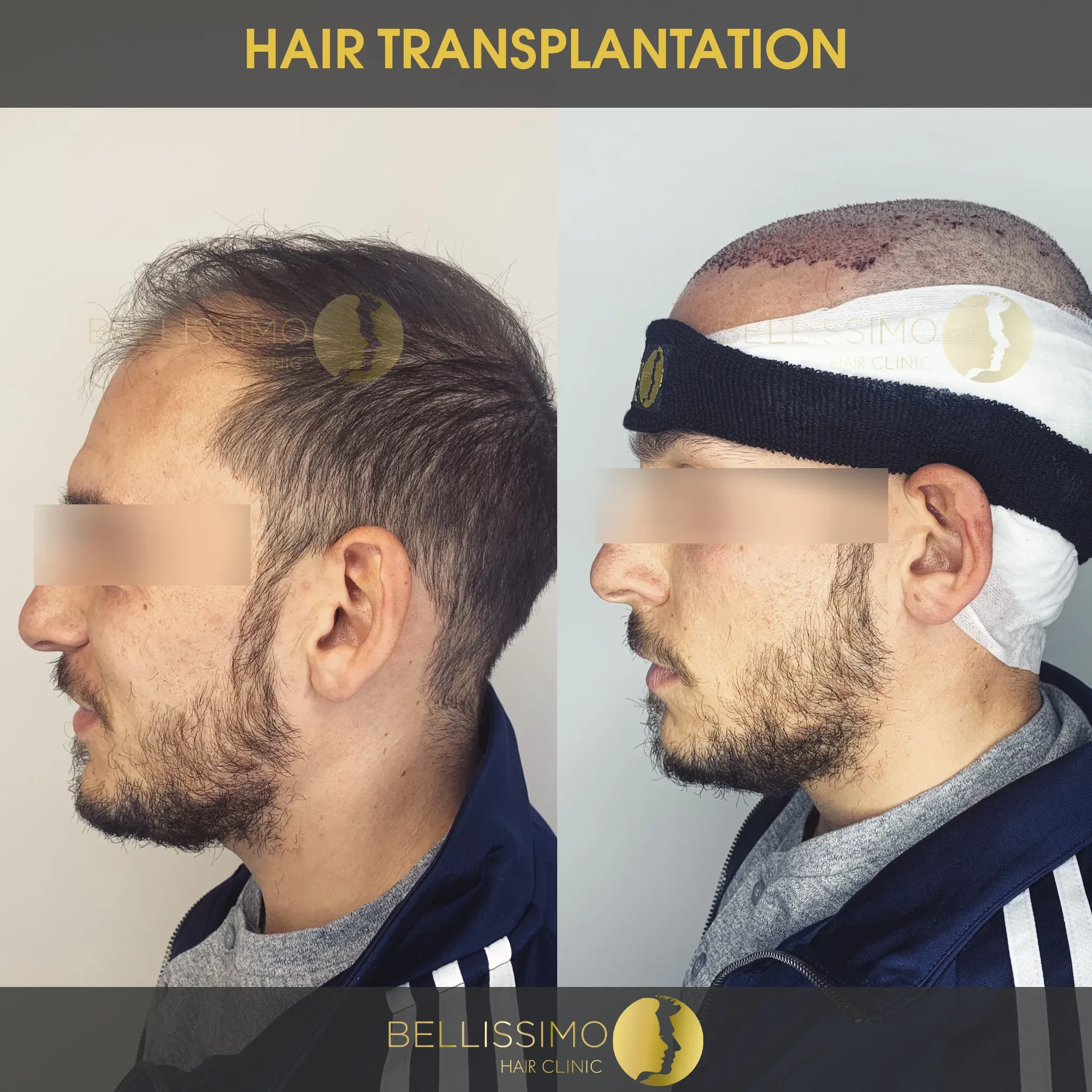 Трансплантация на коса — пациент на Bellissimo Clinic