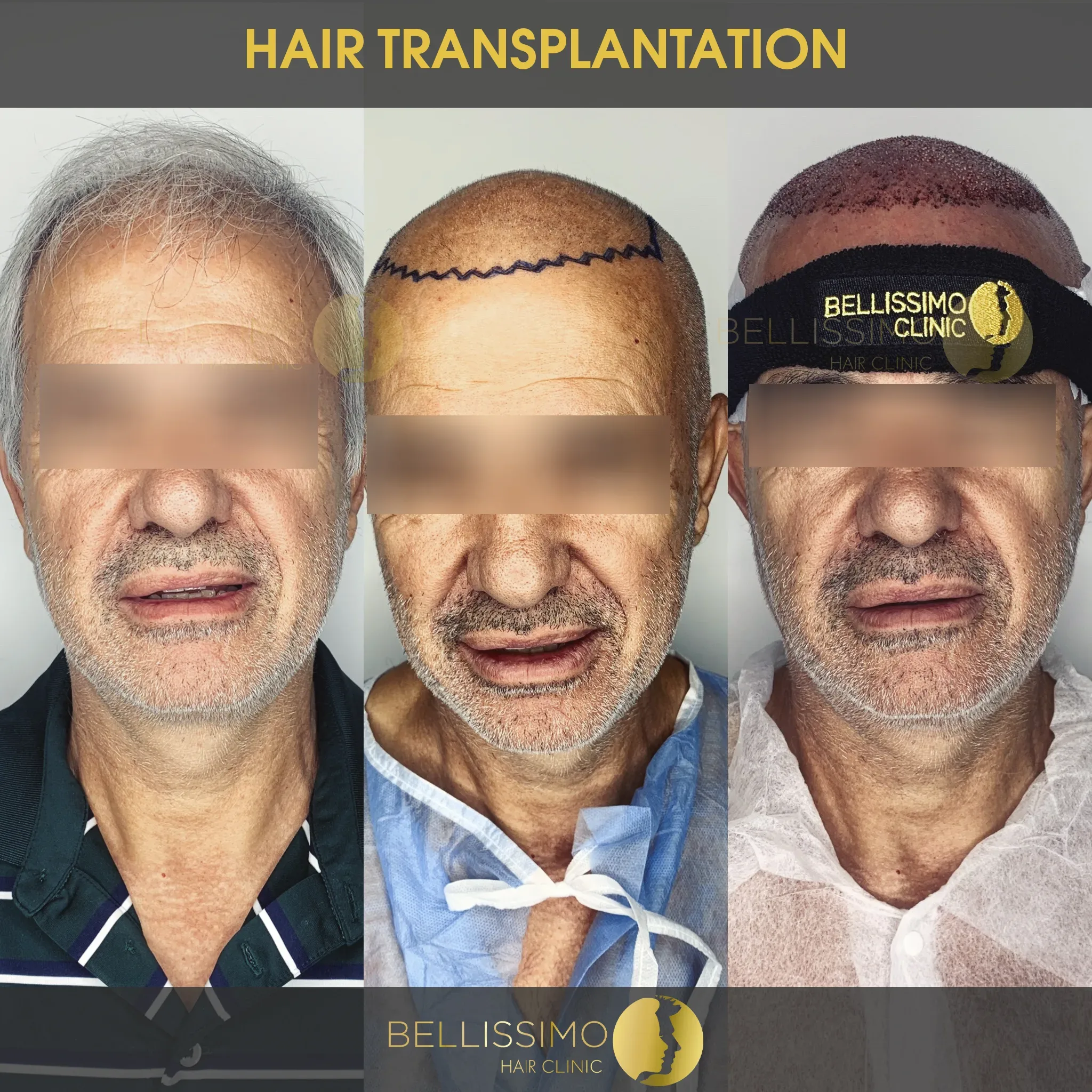 Трансплантация на коса — пациент на Bellissimo Clinic