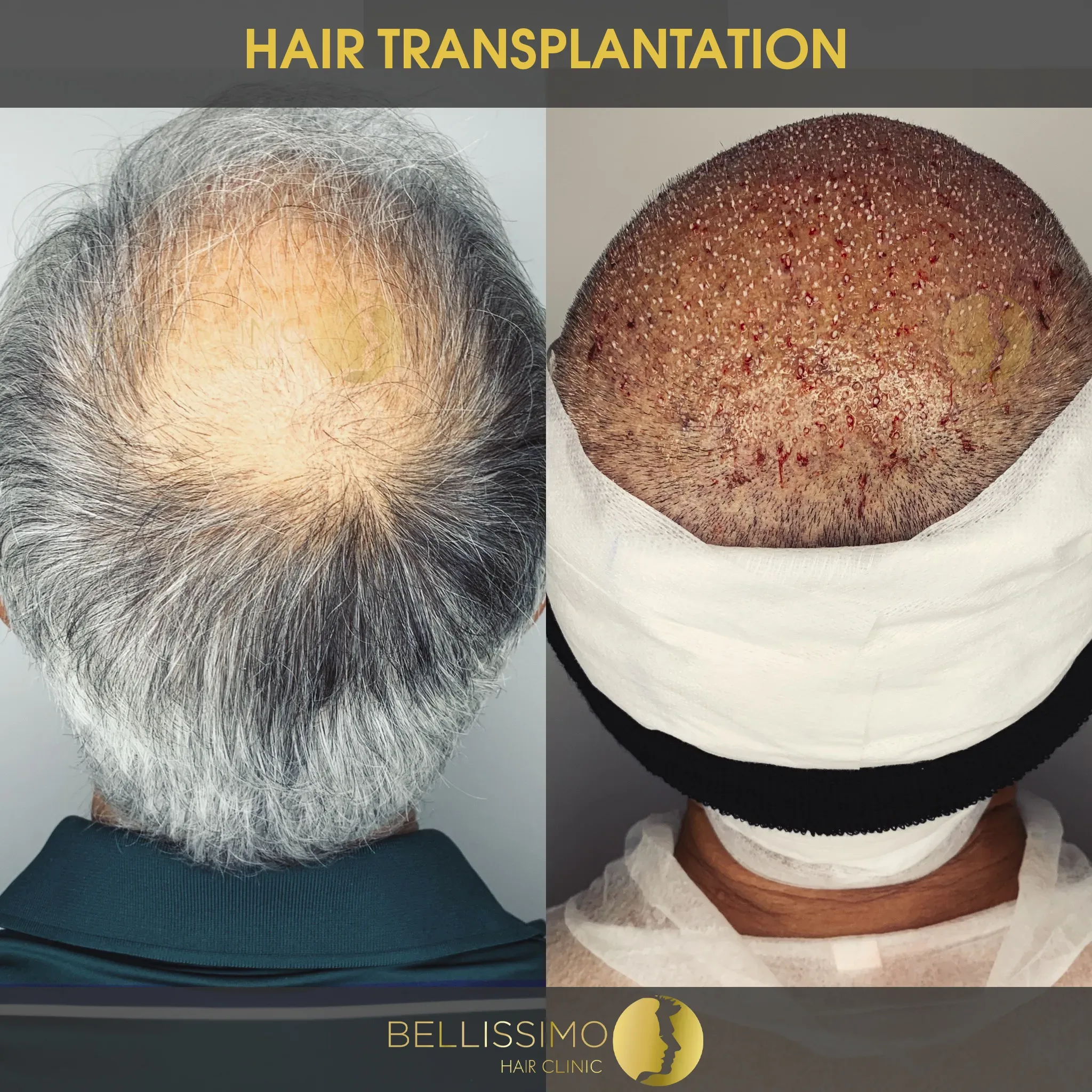Трансплантация на коса — пациент на Bellissimo Clinic