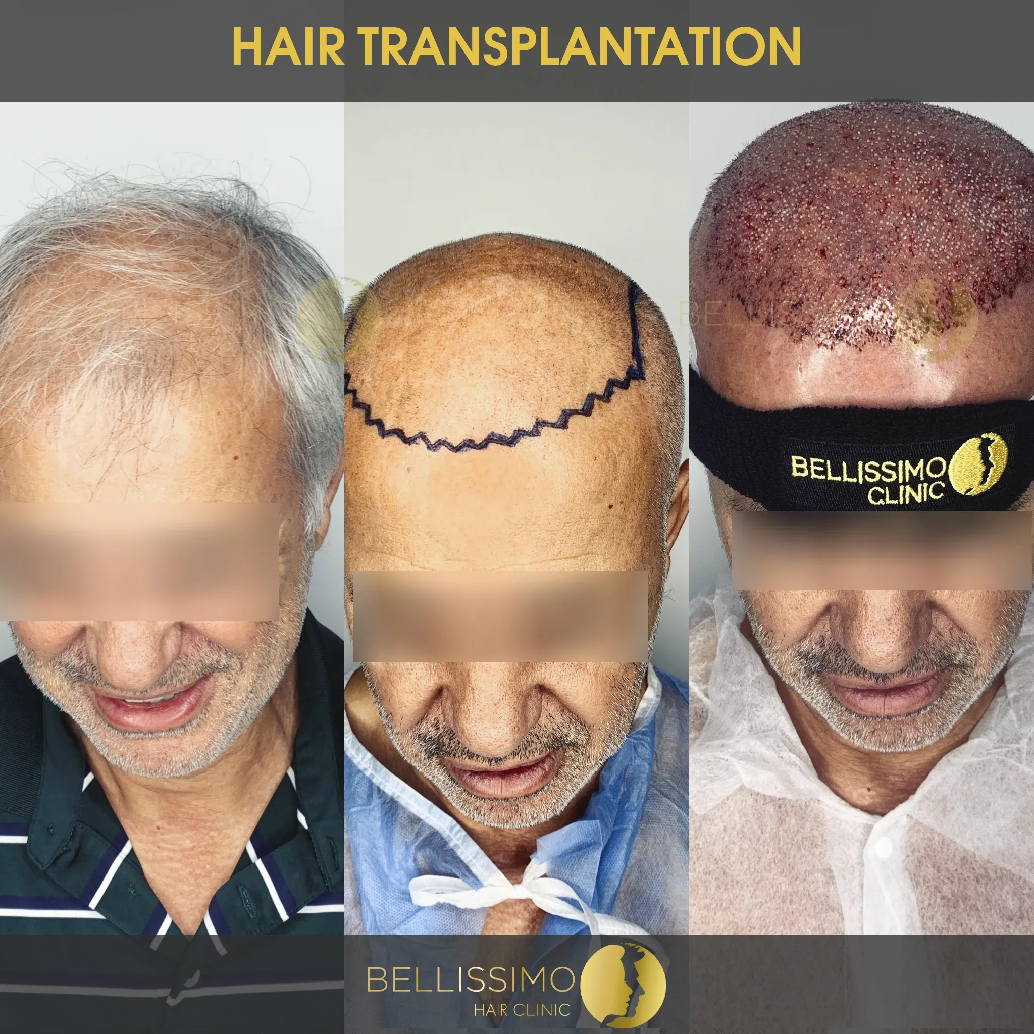 Трансплантация на коса — пациент на Bellissimo Clinic